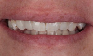 sutton composite bonding