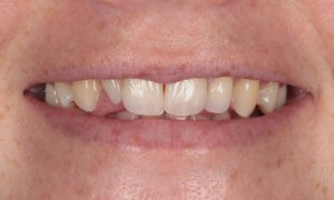 sutton composite bonding